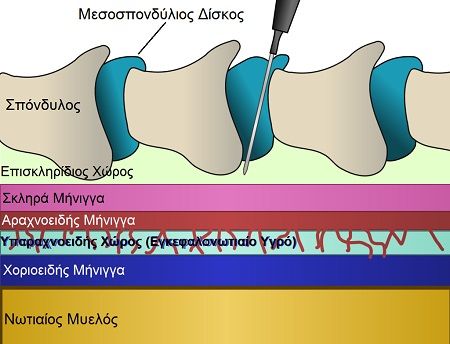 ----------------------------------------------------1024px-Epiduraldiagram 3