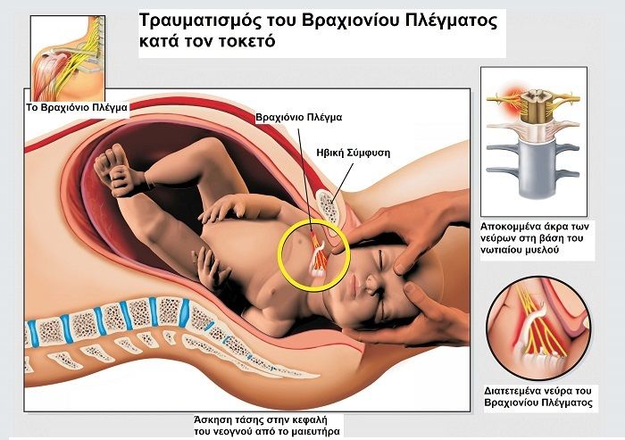------------------------------------------------------------------------------------------------------------------------------brachial plexus injury 3