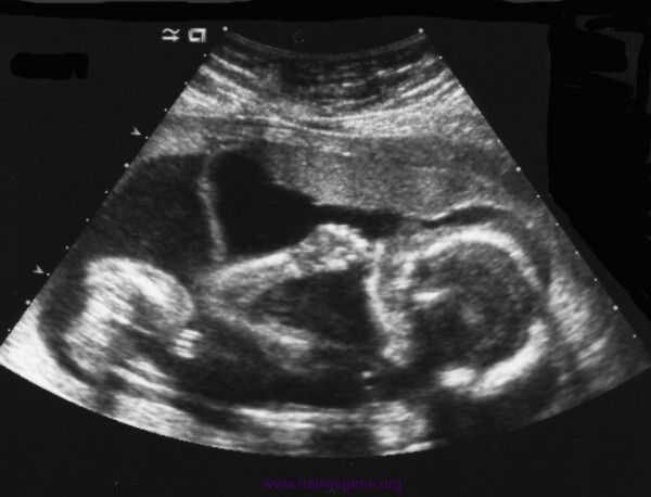 20 hafta fetus ultrason 600x458