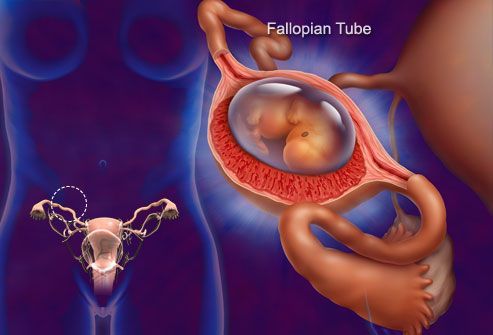 Tubal Ectopic Pregnancy