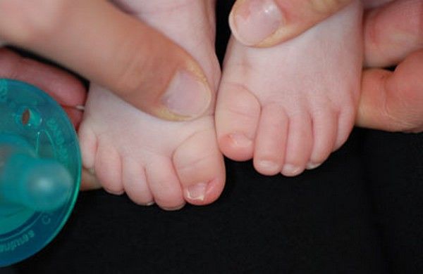 causes of fungal toenail infection in children