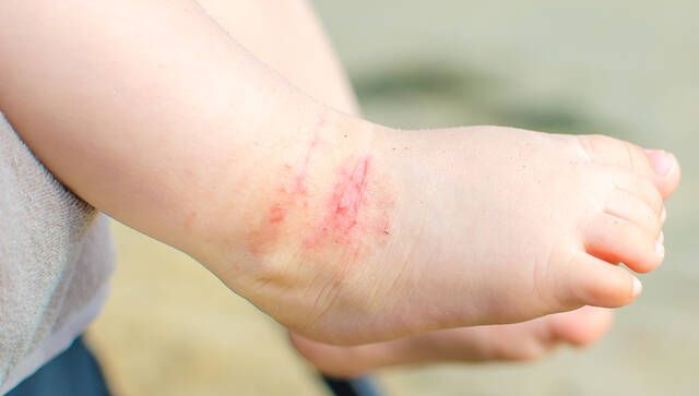 atopiki dermatitida 2